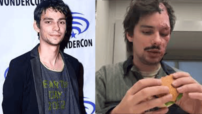 Devon Bostick Face Injury, What Happened to Devon Bostick's Face ...