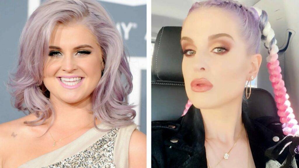 Kelly Osbourne Before and After Surgery