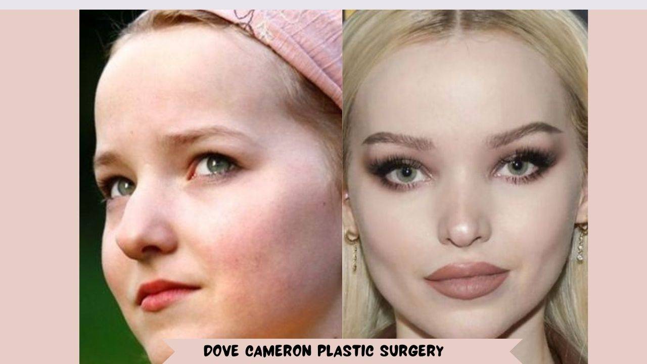 Dove Cameron's Plastic Surgery: How Many Surgeries? 1