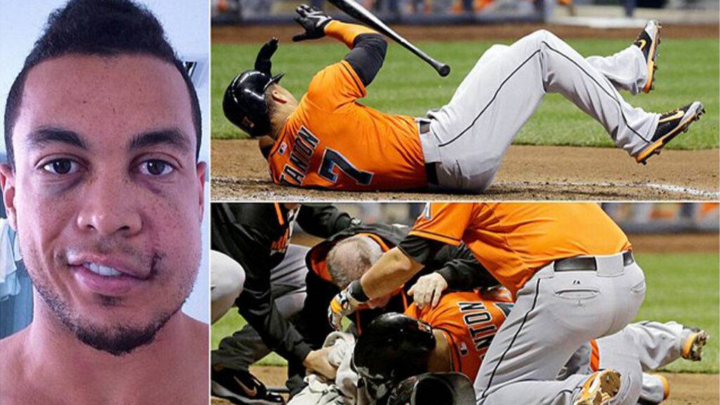 Giancarlo Stanton Face Injury